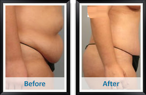 Patient before & after tummy tuck in Atlanta