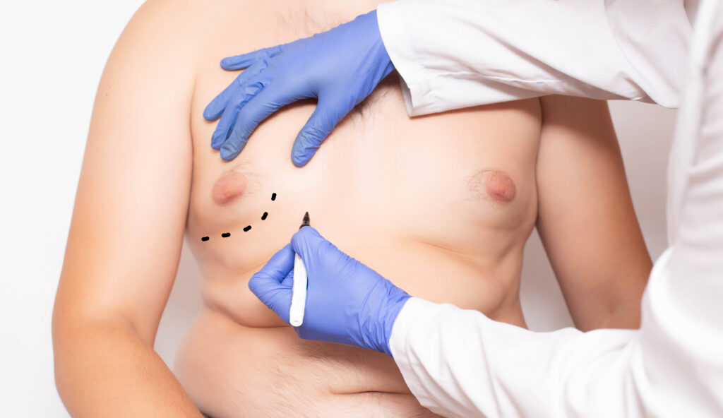 Surgeon plans gynecomastia surgery for a man with oversized breasts