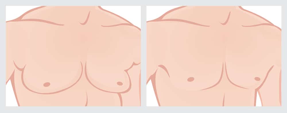 Male,Chest,Reduction.,Illustration,Of,Male,Chest,Before,And,After