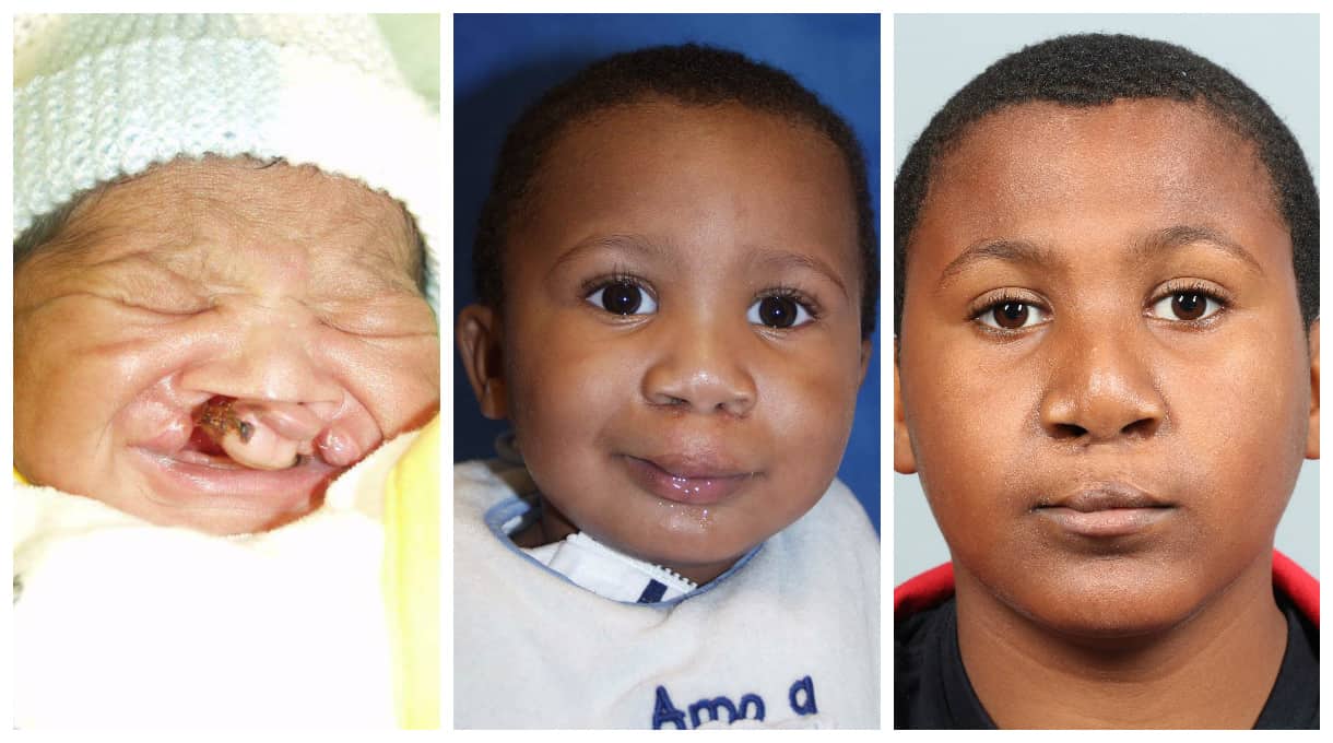 Before and After Image: Cleft Palate - front