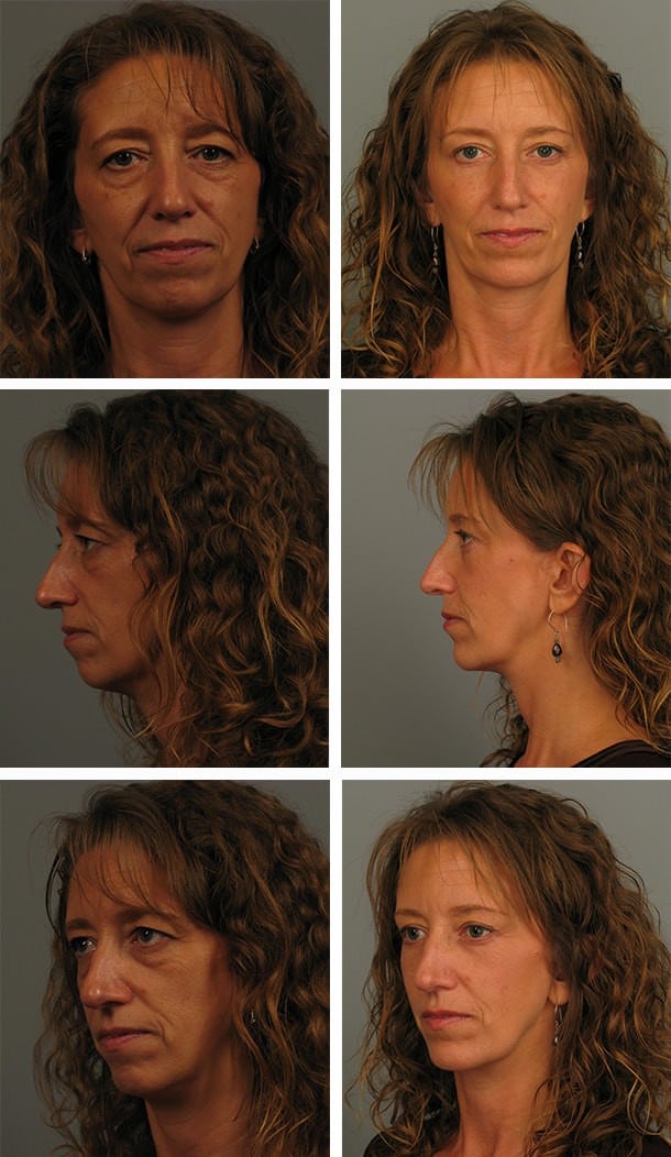 Before and After Image: Blepharoplasty - other