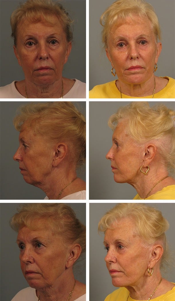 Before and After Image: Blepharoplasty - other