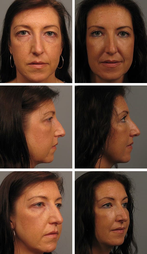 Before and After Image: Blepharoplasty - other