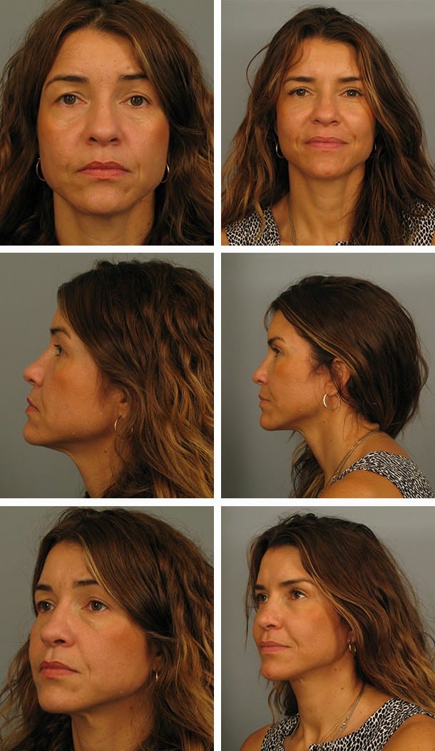 Before and After Image: Blepharoplasty - other