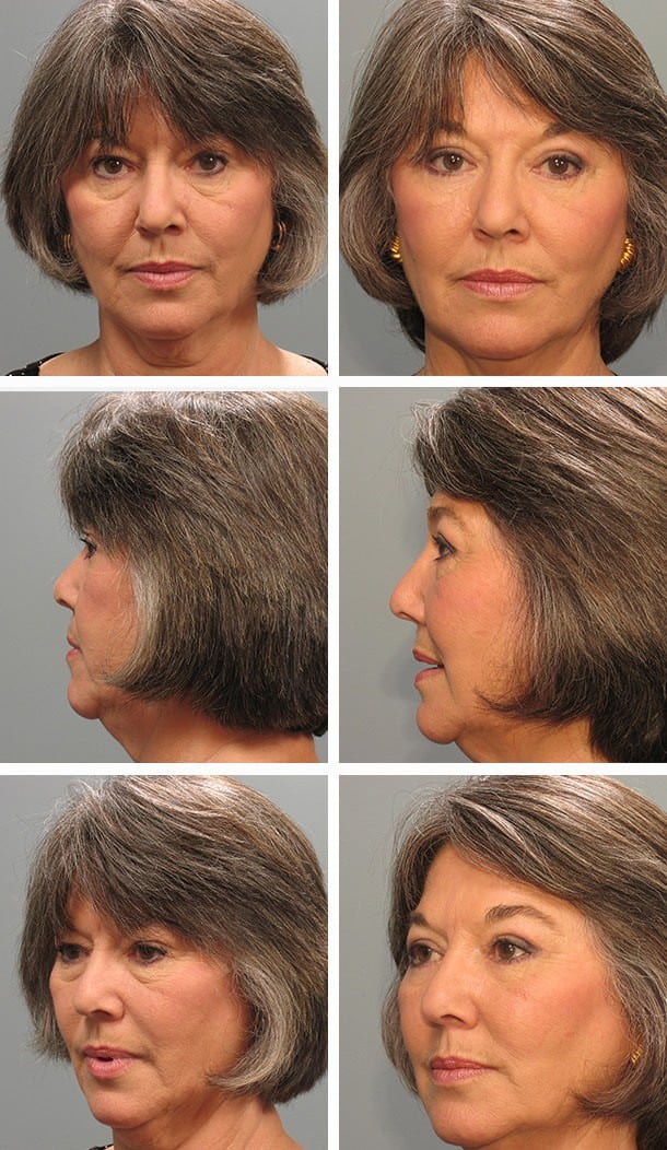 Before and After Image: Blepharoplasty - other