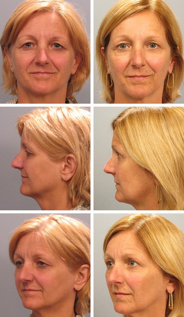 Before and After Image: Blepharoplasty - other