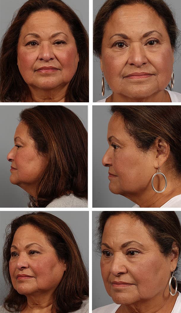 Before and After Image: Blepharoplasty - other