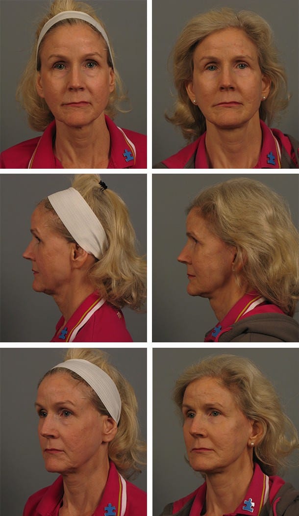 Before and After Image: Blepharoplasty - front