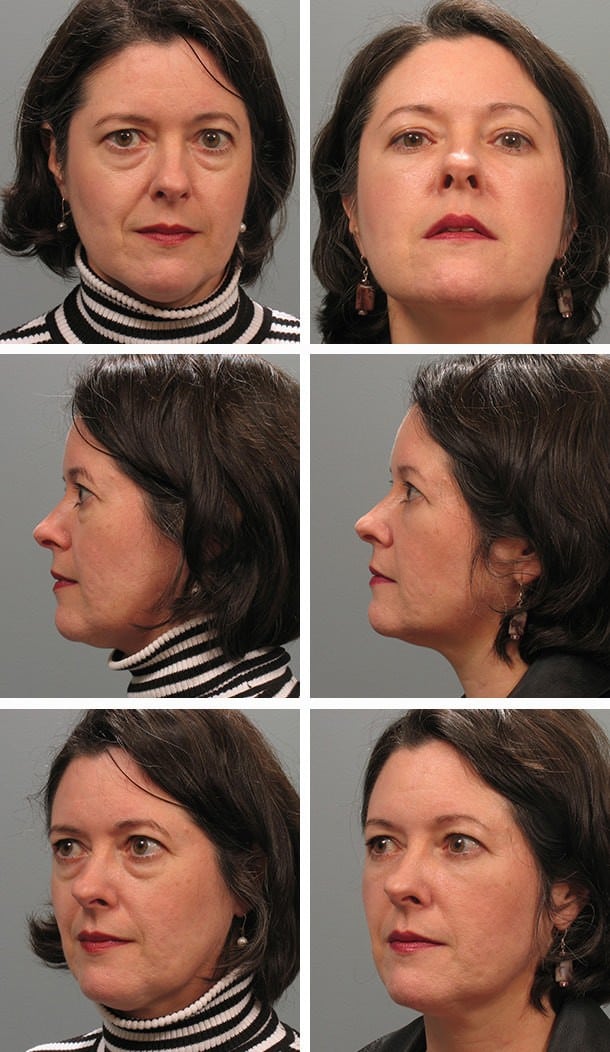 Before and After Image: Blepharoplasty - other