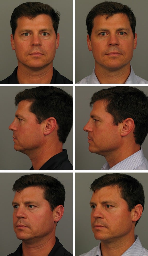 Before and After Image: Blepharoplasty - other