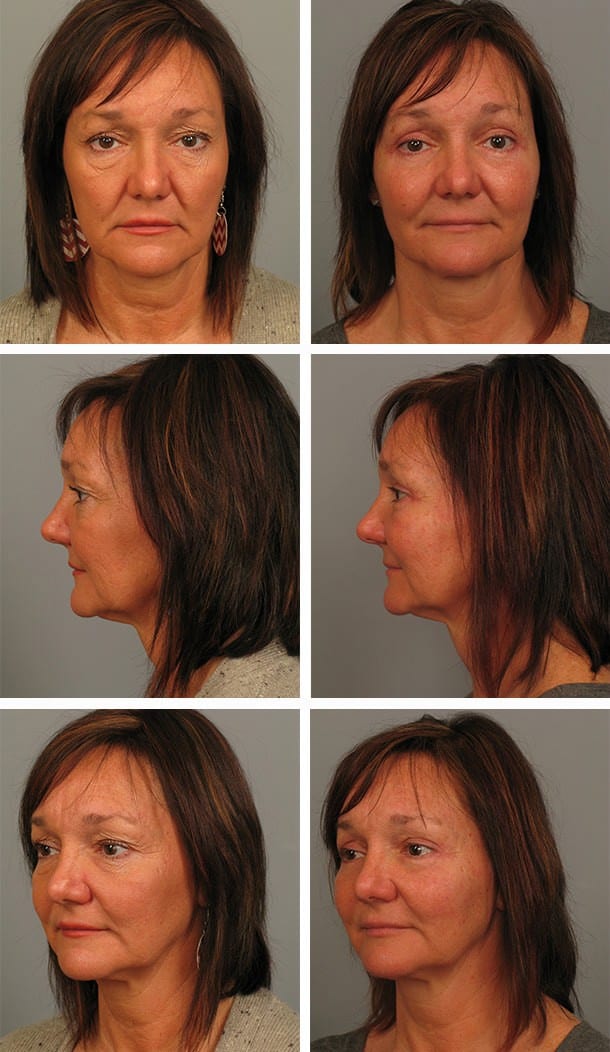 Before and After Image: Blepharoplasty - other