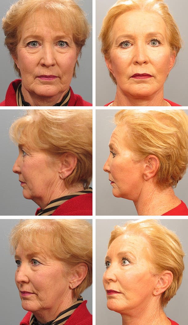 Before and After Image: Blepharoplasty - other