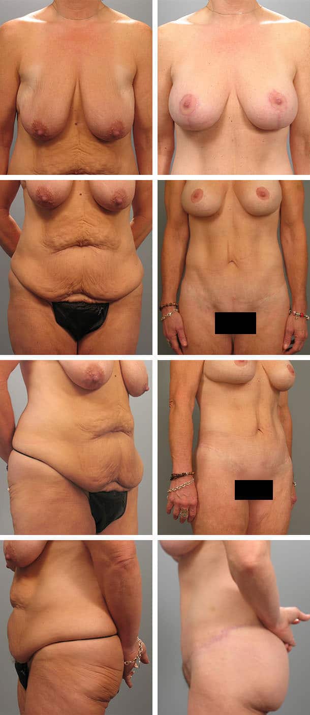 Before and After Image: Body Lift - other