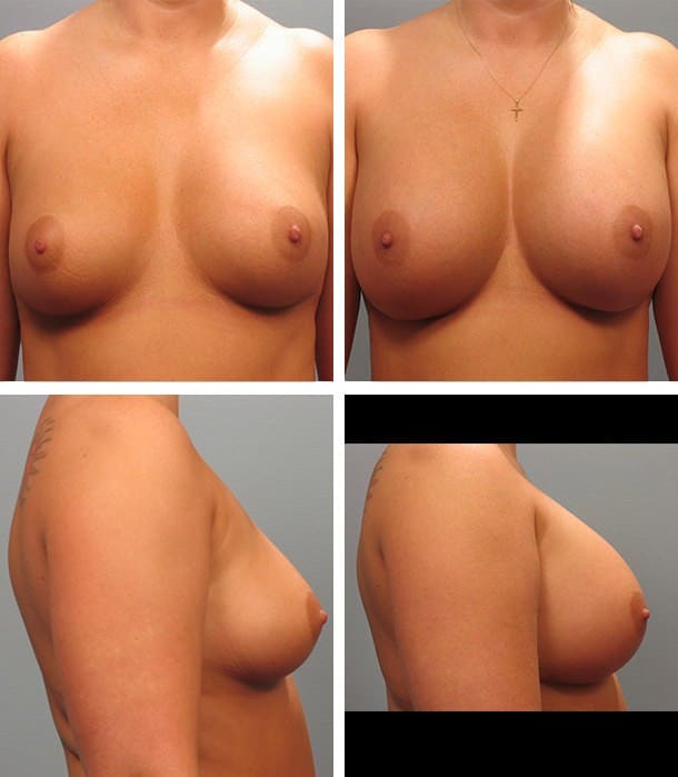 Before and After Image: Breast Augmentation - other