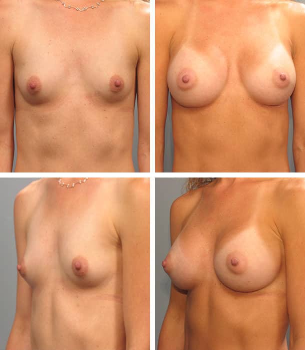 Before and After Image: Breast Augmentation - other