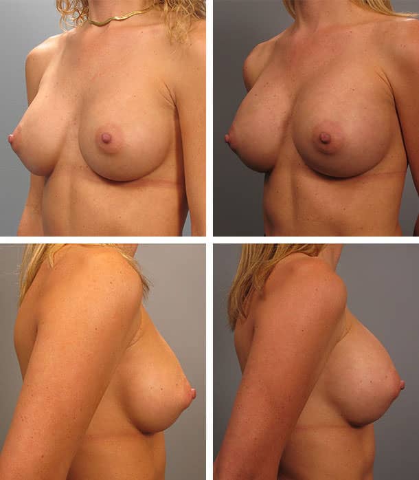 Before and After Image: Breast Augmentation - other