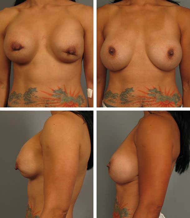 Before and After Image: Breast Augmentation - other