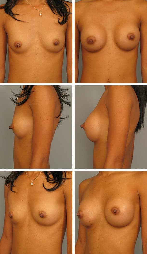 Before and After Image: Breast Augmentation - other