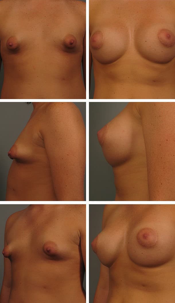 Before and After Image: Breast Augmentation - other