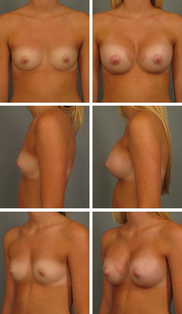 Before and After Image: Breast Augmentation - other