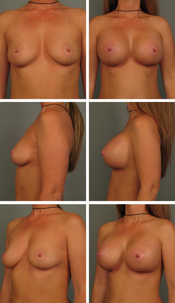 Before and After Image: Breast Augmentation - other