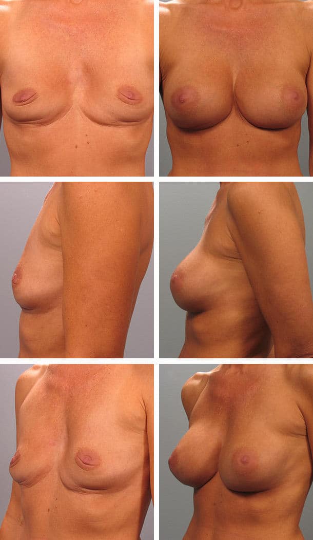 Before and After Image: Breast Augmentation - other