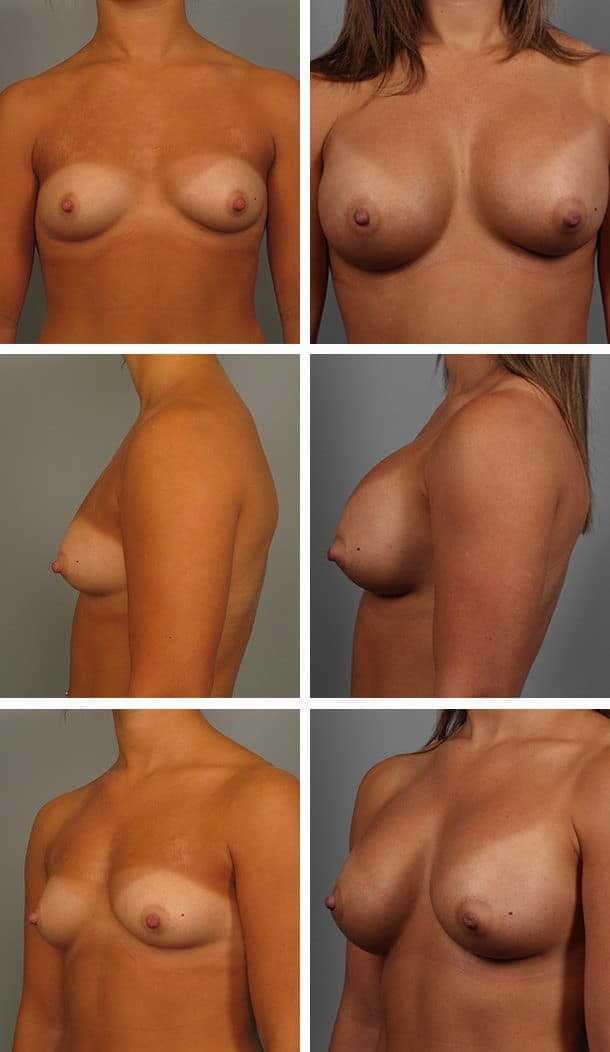 Before and After Image: Breast Augmentation - other