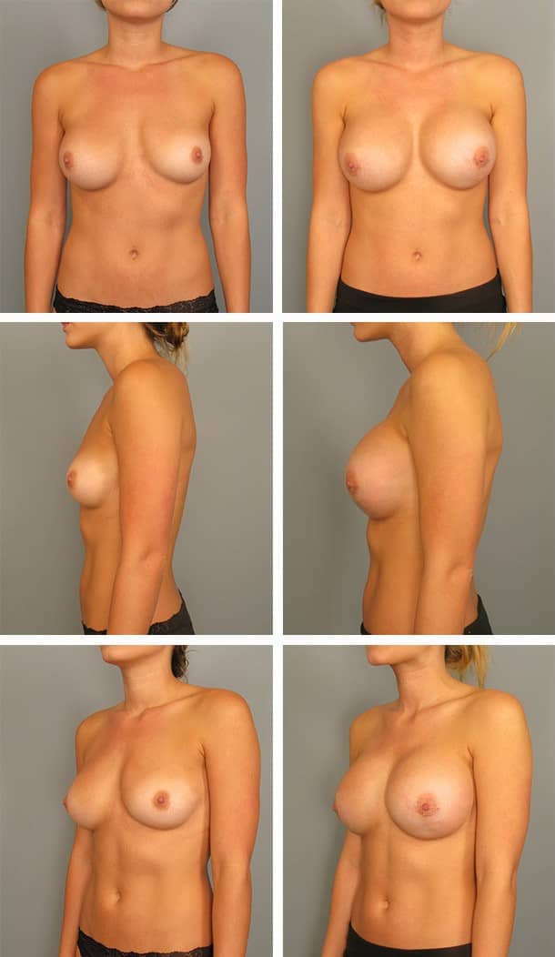 Before and After Image: Breast Augmentation - other