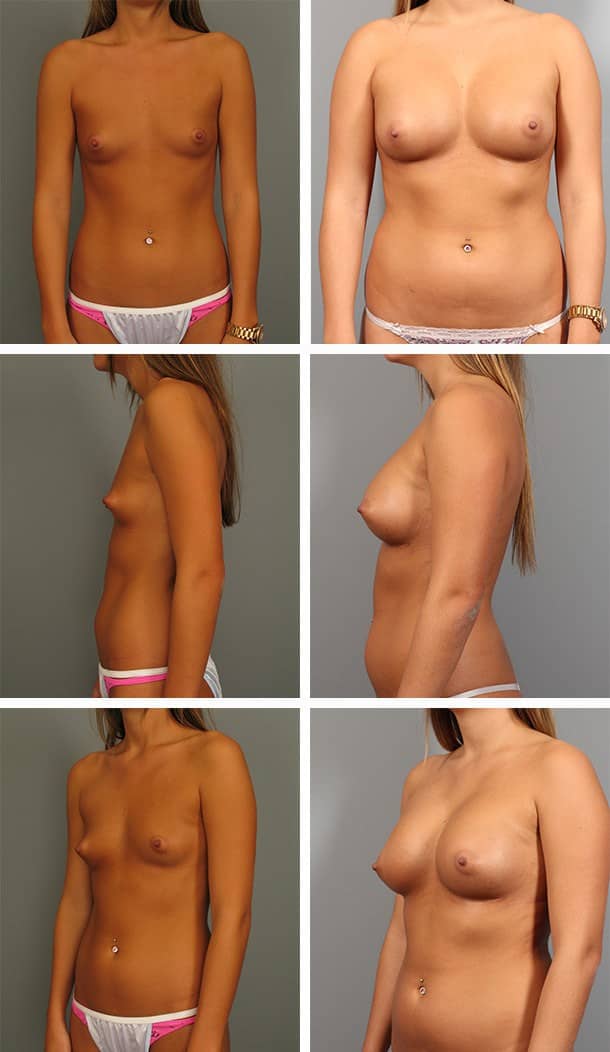 Before and After Image: Breast Augmentation - other