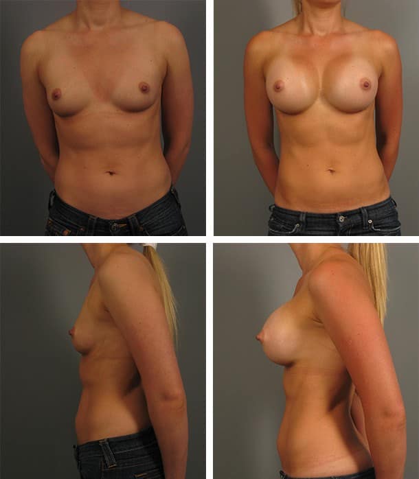 Before and After Image: Breast Augmentation - other
