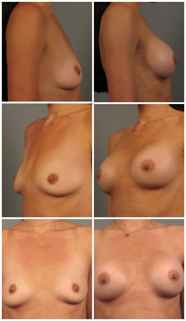 Before and After Image: Breast Augmentation - other