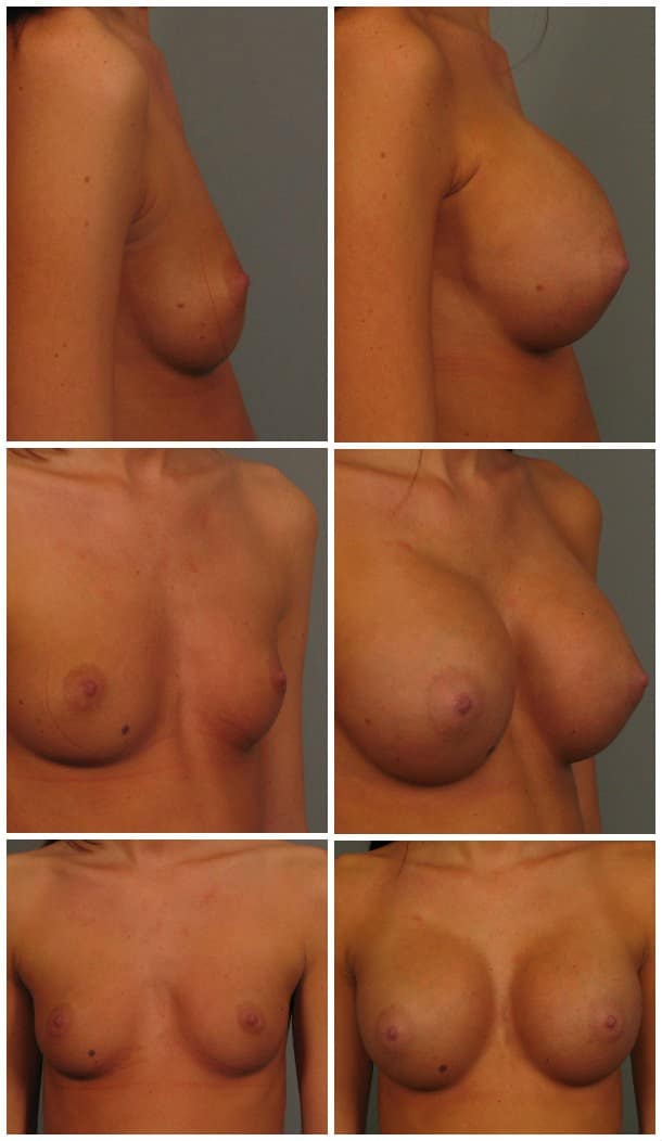 Before and After Image: Breast Augmentation - other