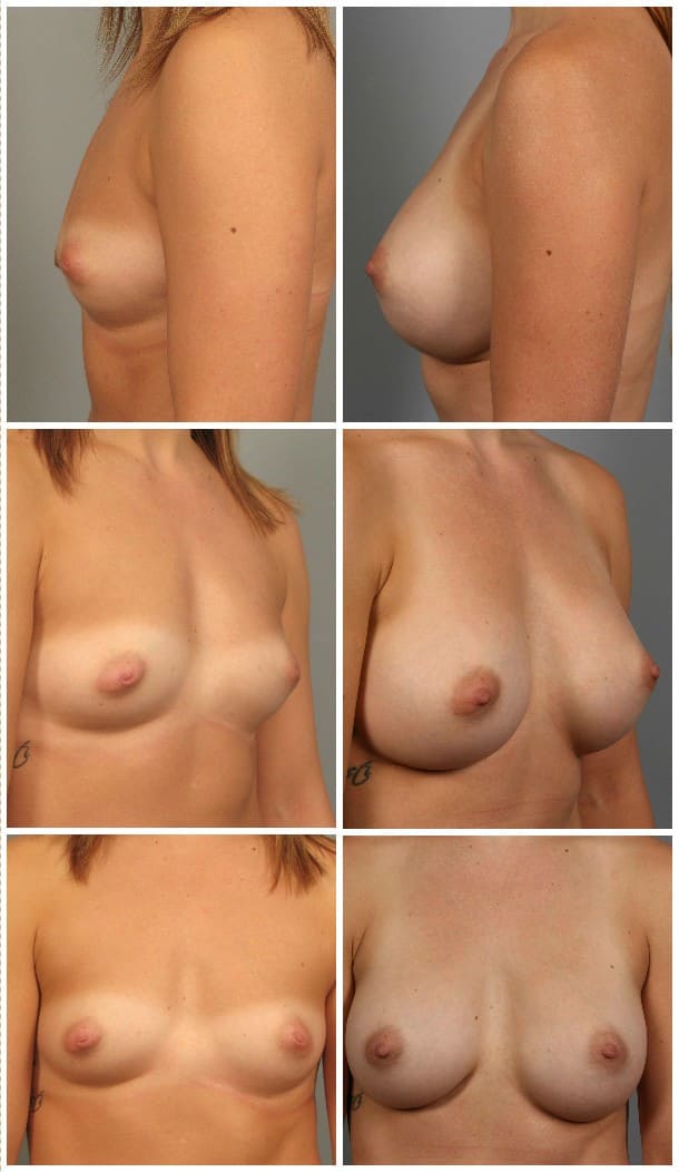 Before and After Image: Breast Augmentation - other
