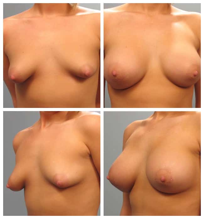 Before and After Image: Breast Augmentation - other