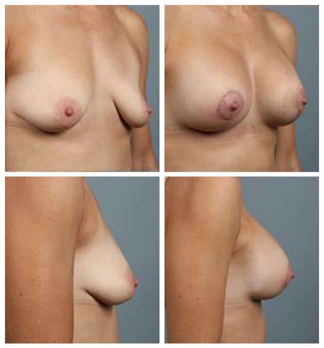 Before and After Image: Breast Augmentation - other