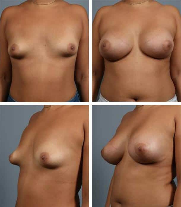 Before and After Image: Breast Augmentation - other