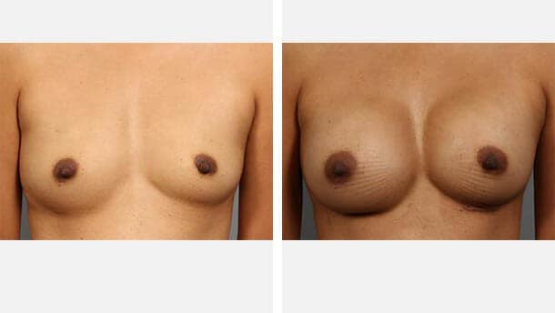Before and After Image: Breast Augmentation - front