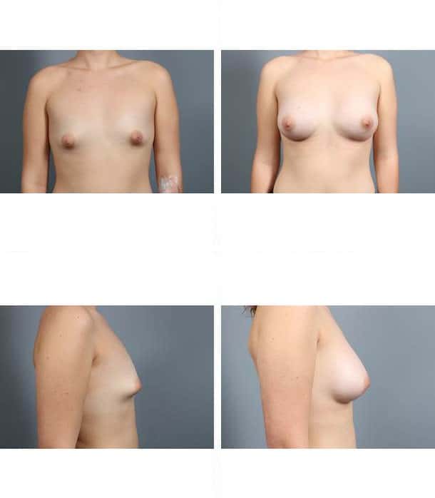 Before and After Image: Breast Augmentation - other