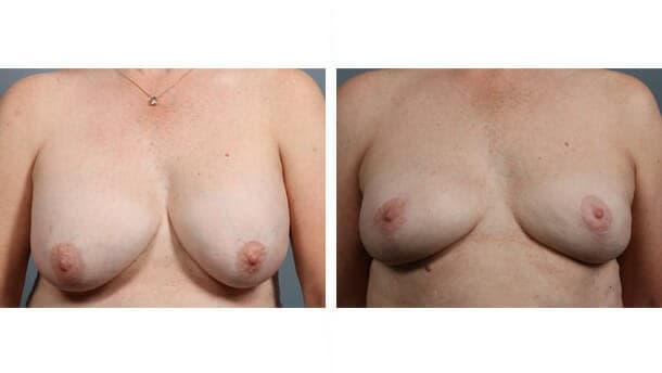 Before and After Image: Breast Implant Removal - front