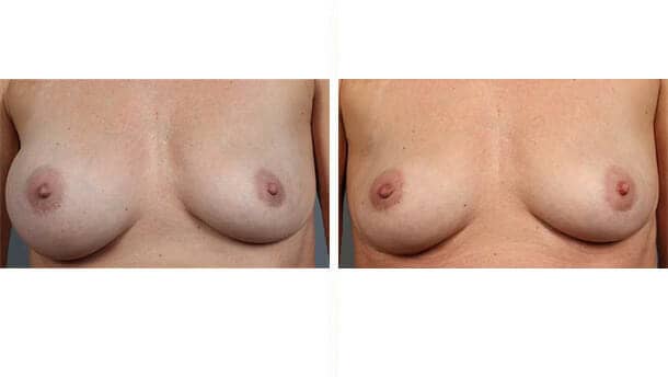 Before and After Image: Breast Implant Removal - front