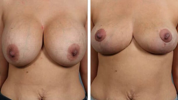 Before and After Image: Breast Implant Removal - front