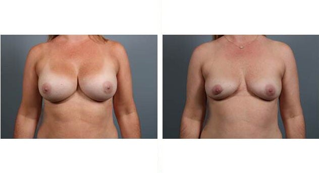 Before and After Image: Breast Implant Removal - front