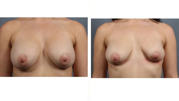 Before and After Image: Breast Implant Removal - front