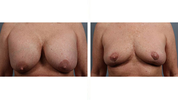 Before and After Image: Breast Implant Removal - front