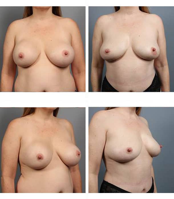 Before and After Image: Breast Implant Removal - other