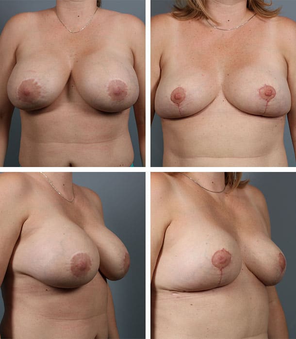 Before and After Image: Breast Implant Removal - front