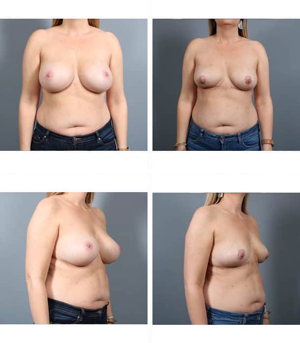 Before and After Image: Breast Implant Removal - front
