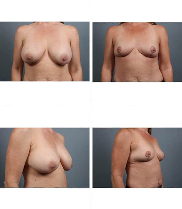 Before and After Image: Breast Implant Removal - other