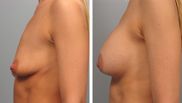 Before and After Image: Breast Lift - left-side