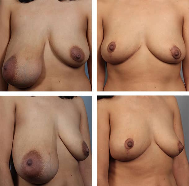 Before and After Image: Breast Lift - other